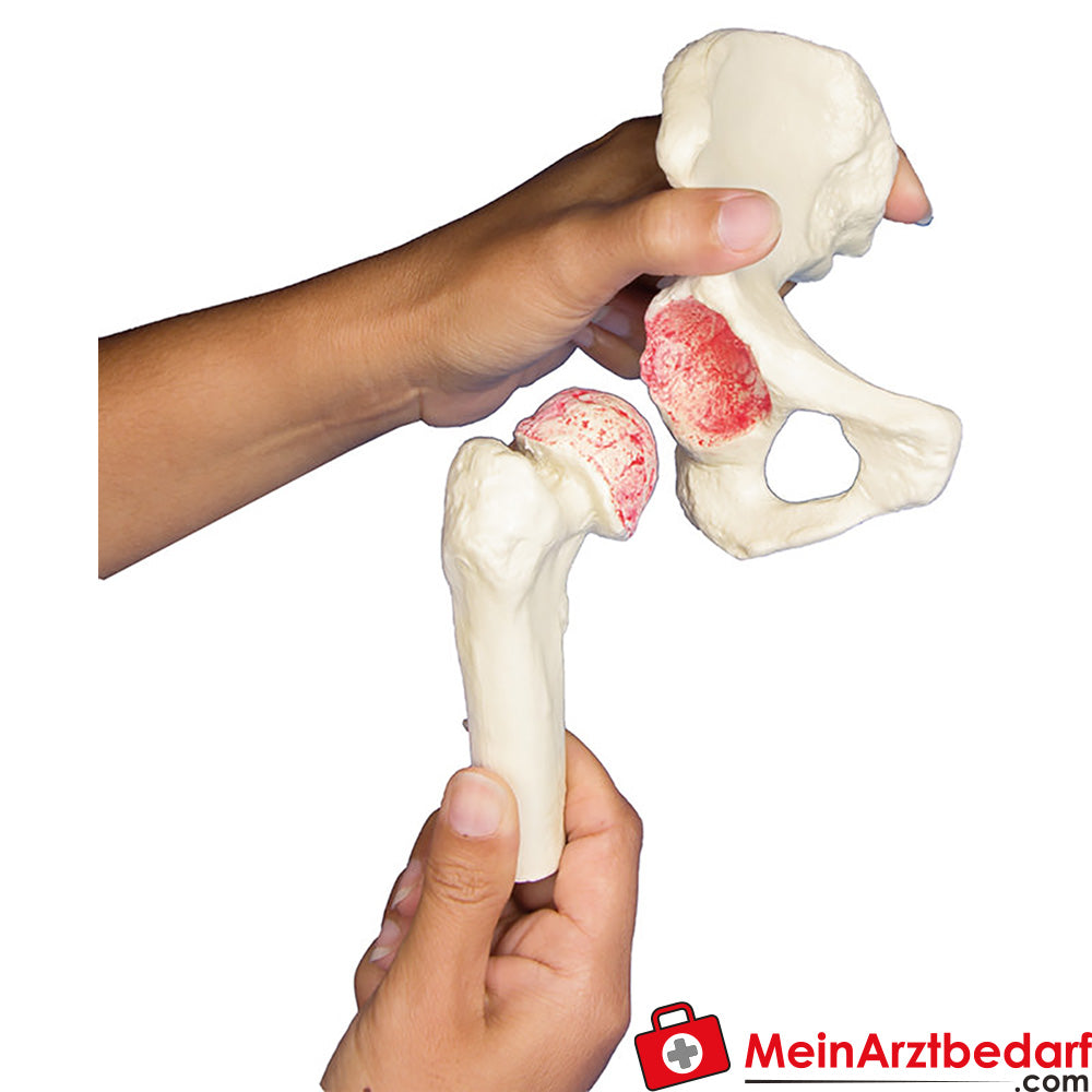Erler-Zimmer Hüft-Implantat-Modell.