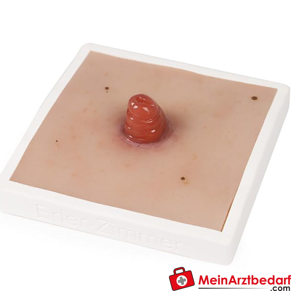 Erler-Zimmer Wundmoulage inkl. Stativ.