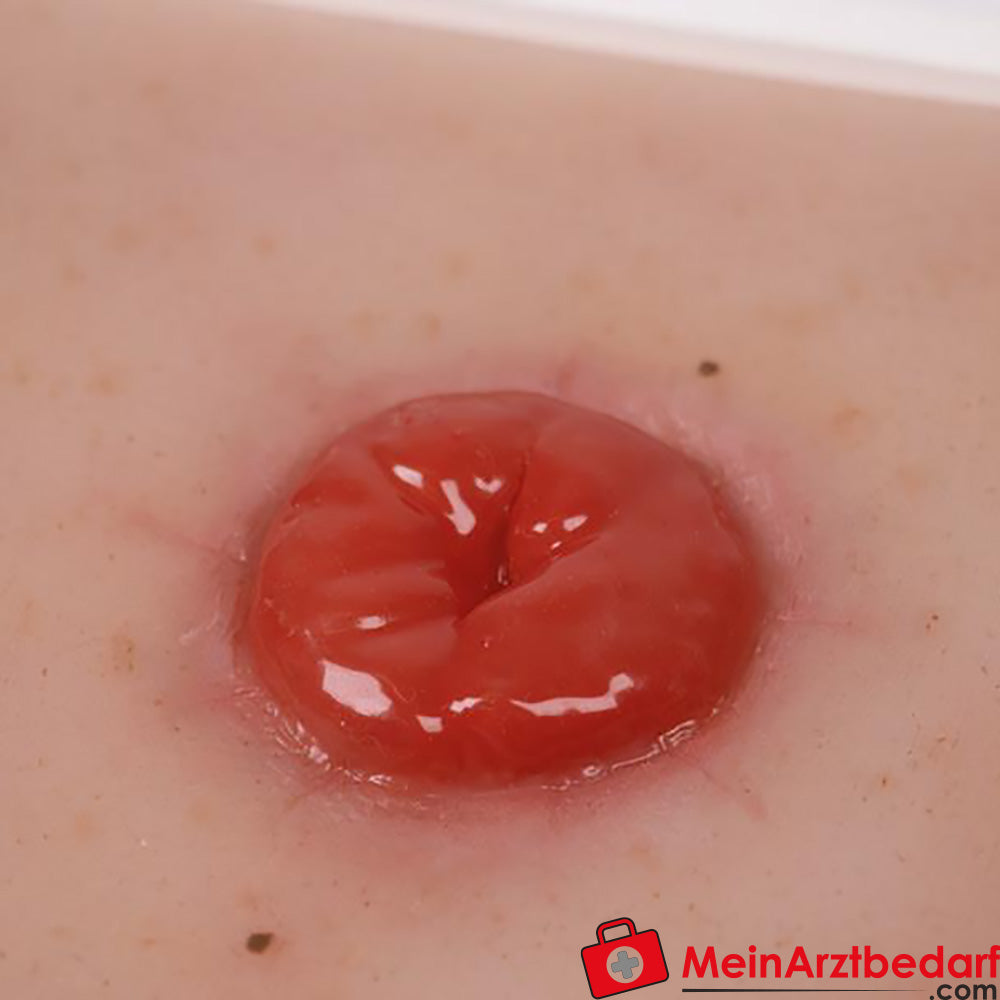 Erler-Zimmer Wundmoulage inkl. Stativ.