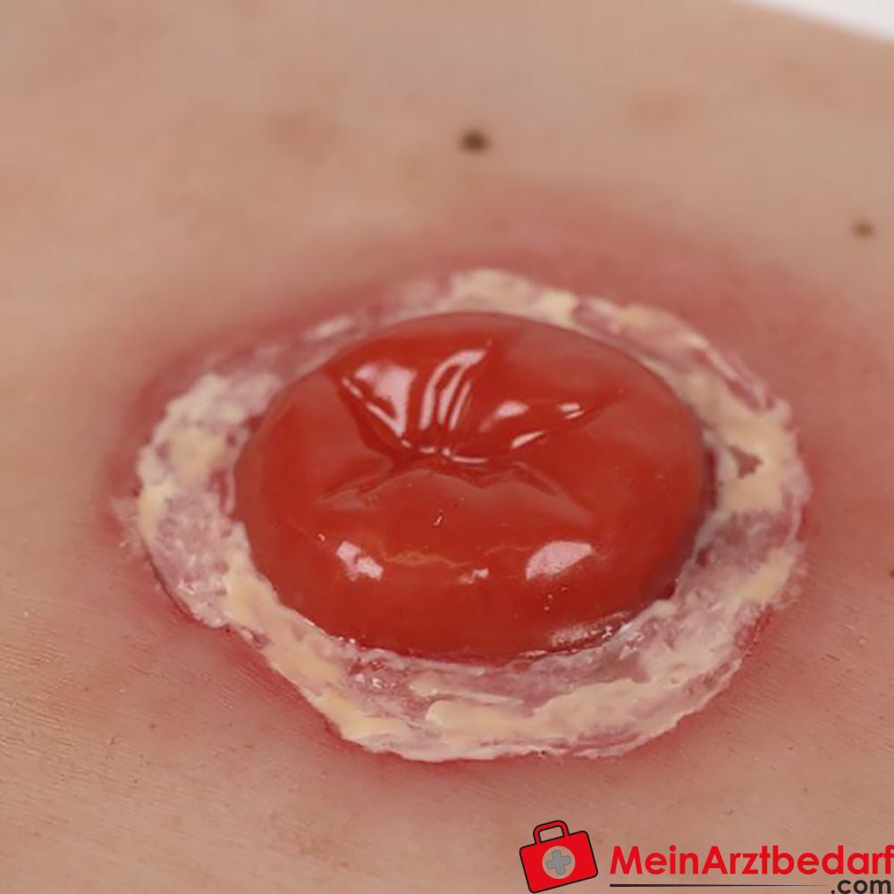 Erler-Zimmer Wundmoulage inkl. Stativ.