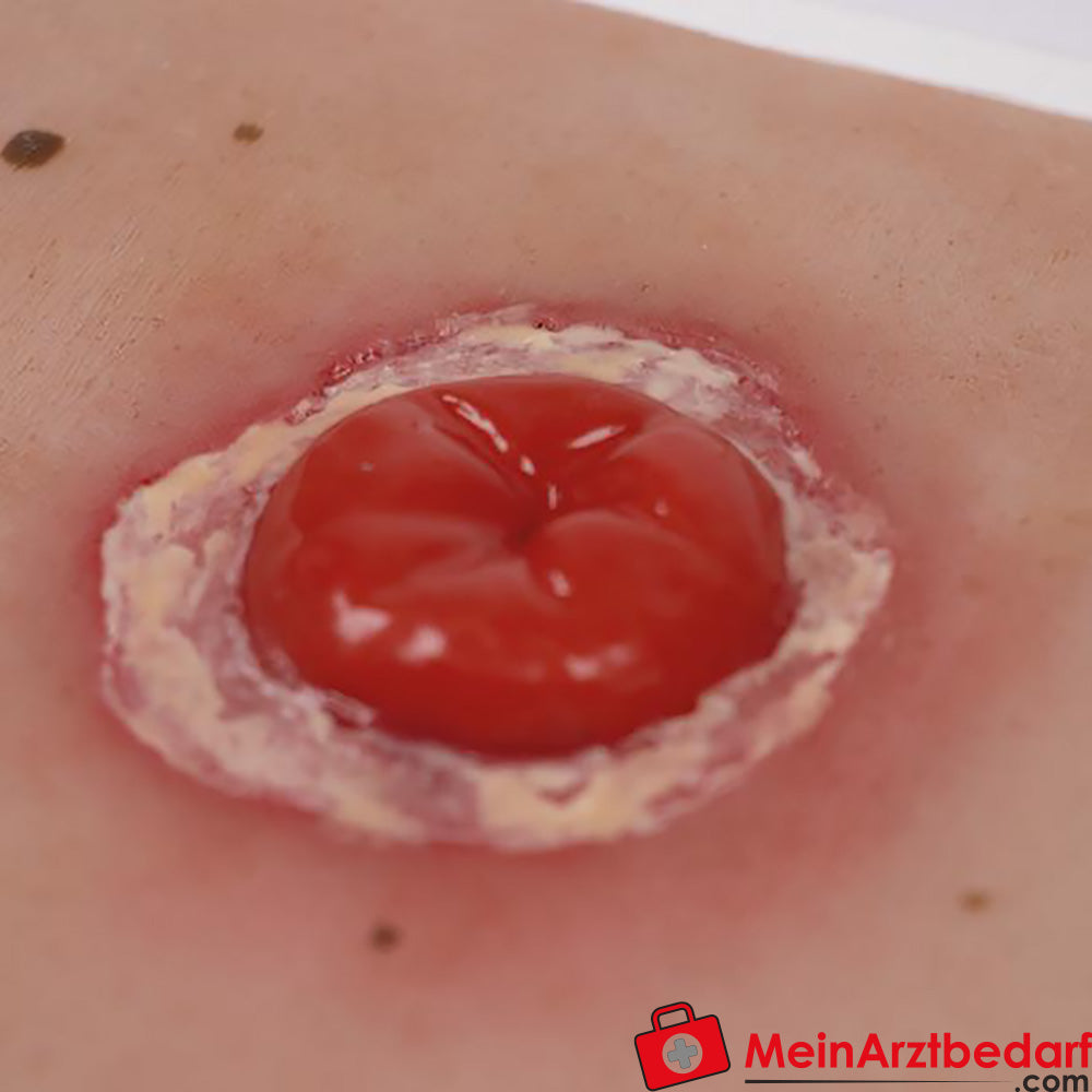 Erler-Zimmer Wundmoulage inkl. Stativ.