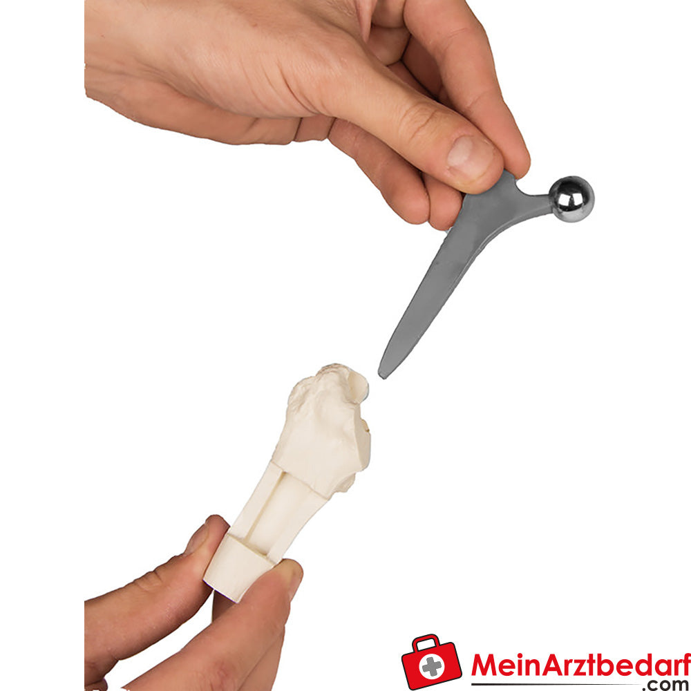 Erler-Zimmer Hüft-Implantat-Modell.