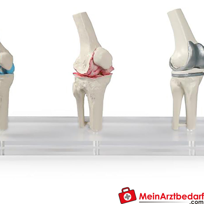 Modelo de prótesis de rodilla Erler - zimer