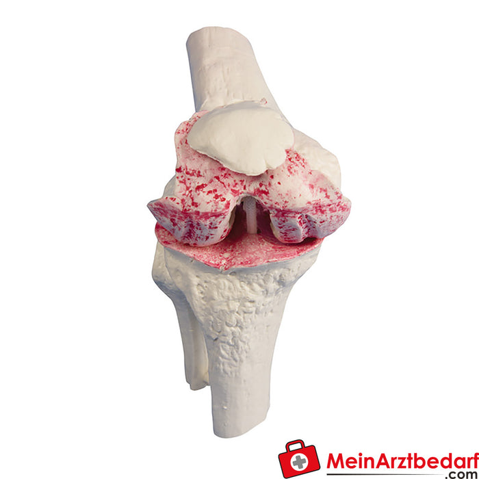 Modelo de prótesis de rodilla Erler - zimer