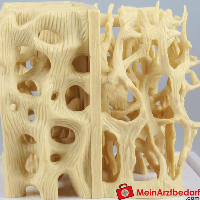 Modelo comparativo de Erler Zimmer entre estructura ósea sana y osteoporótica