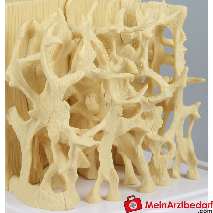 Erler Zimmer Comparison model healthy / osteoporotic bone structure