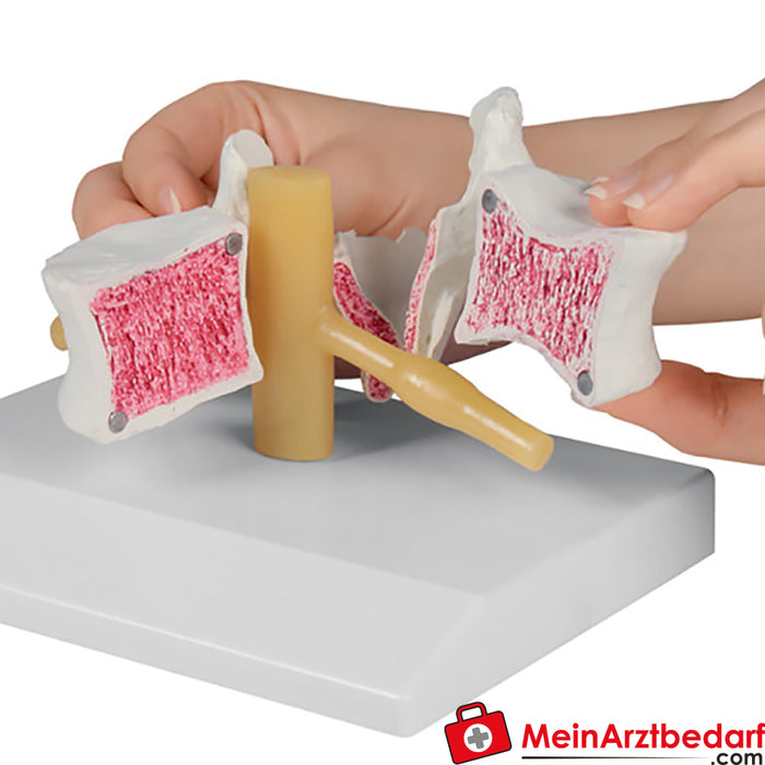 Osteoporosis de Erler Zimmer