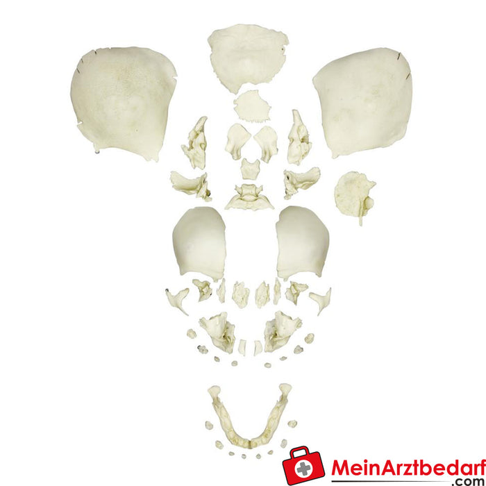 Erler Zimmer Crâne de fœtus humain éclaté, entièrement développé