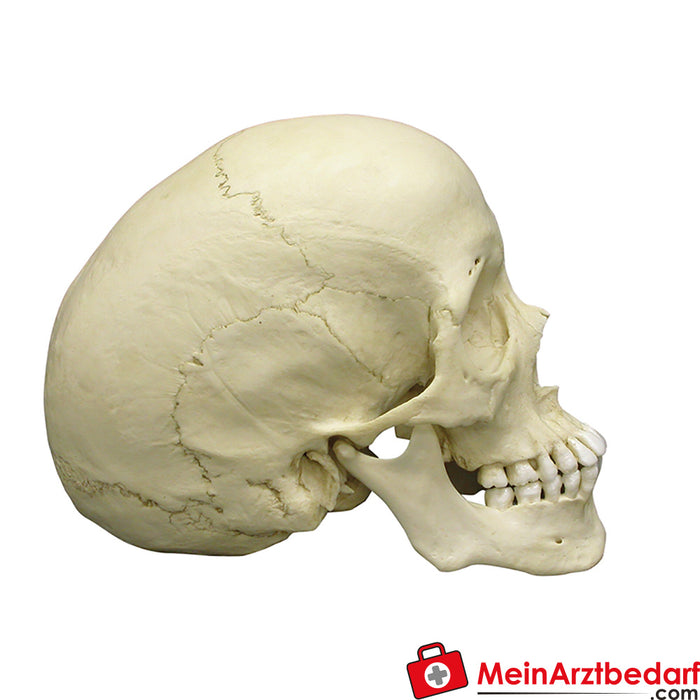 Erler Zimmer Scaphocephalic skull
