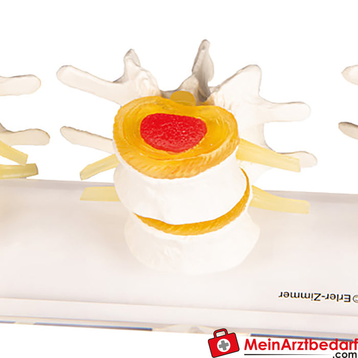 Erler Zimmer Stages of disc damage