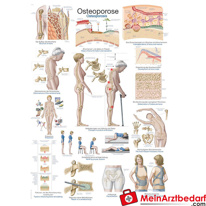 Erler Zimmer Painel de ensino "Osteoporose"