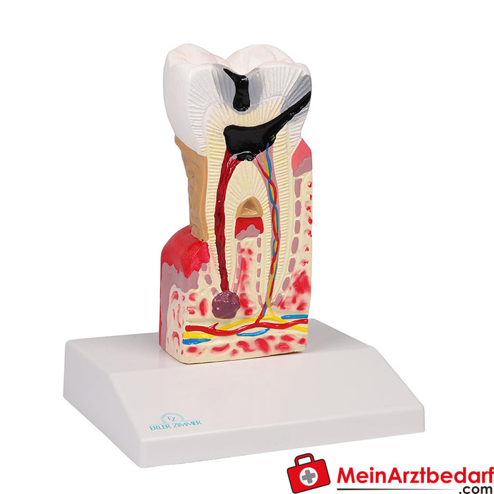 Modelo de caries dental Erler Zimmer - 10 veces el tamaño