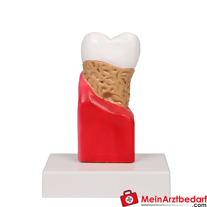 Erler Zimmer Zahnkariesmodell - 10-fache Größe