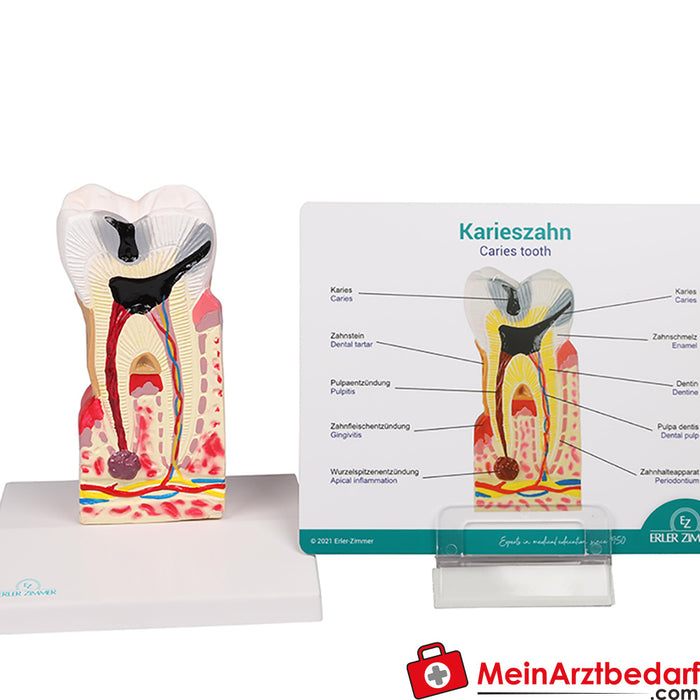 Erler Zimmer Dental caries model - 10x size