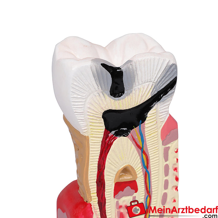 Erler Zimmer Tandcariësmodel - 10x zo groot