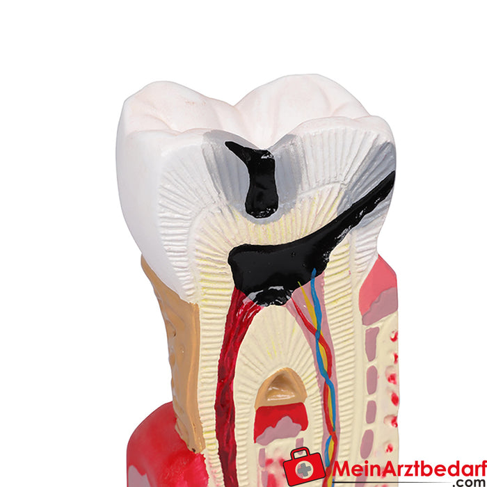 Erler Zimmer Zahnkariesmodell - 10-fache Größe