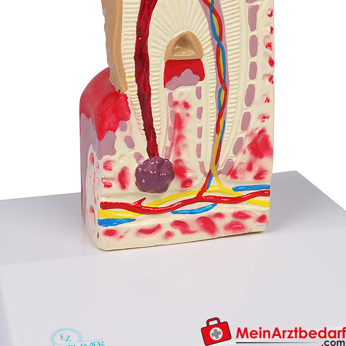 Modelo de caries dental Erler Zimmer - 10 veces el tamaño