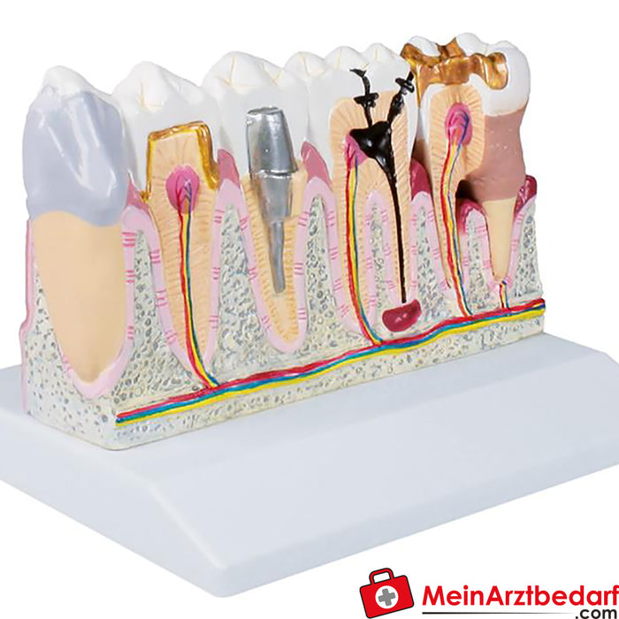 Modelo dental Erler Zimmer, tamaño 4x - Anatomía aumentada EZ