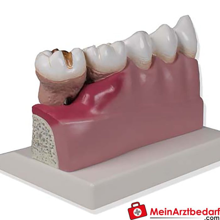 Erler Zimmer 牙科模型，4 倍大小 - EZ 增强解剖学