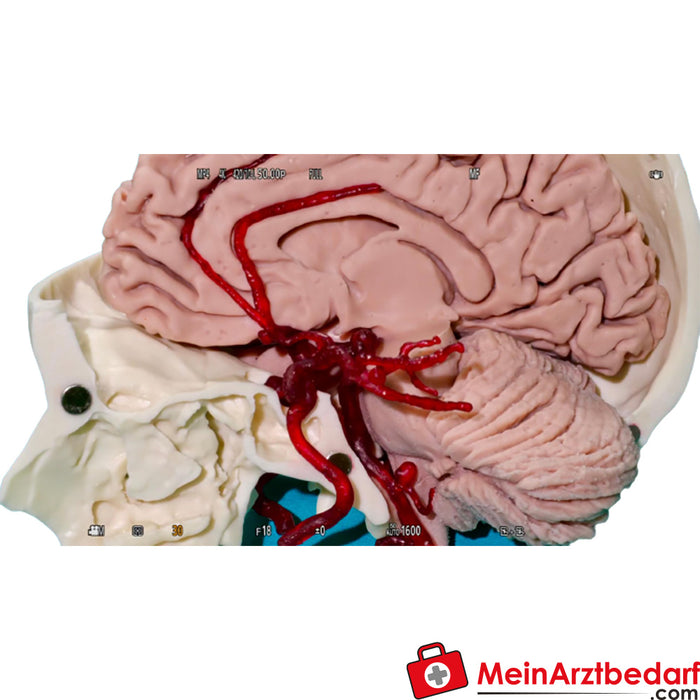 Erler Zimmer Conjunto de artérias cerebrais, aneurisma e saudável