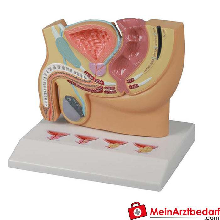 Erler Zimmer Male pelvic section with prostate disease