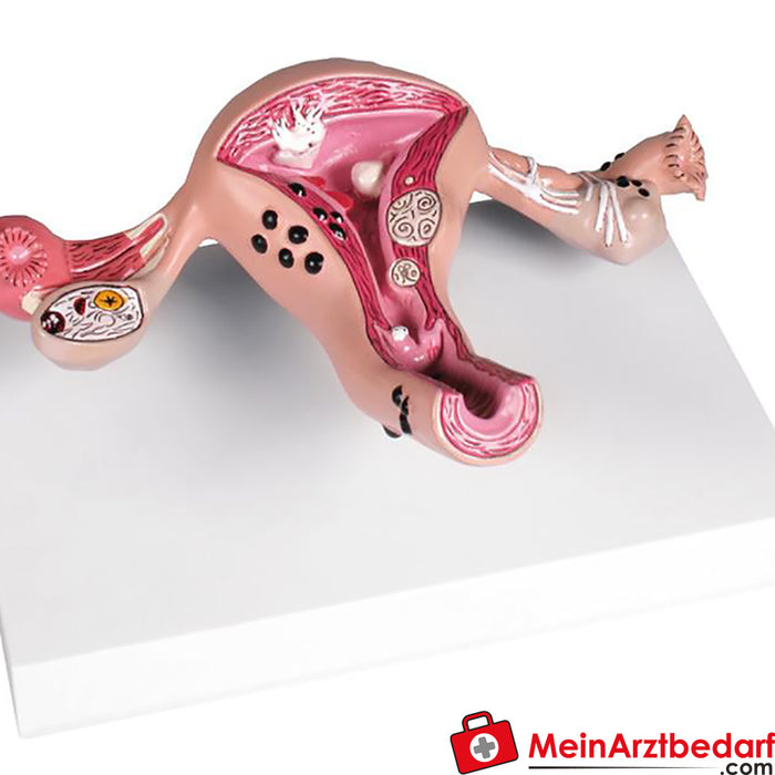 Erler Zimmer Uterus model