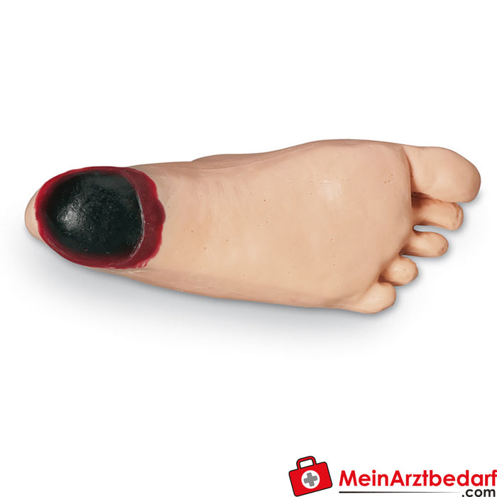 Erler Zimmer Edema foot with deep tissue necrosis