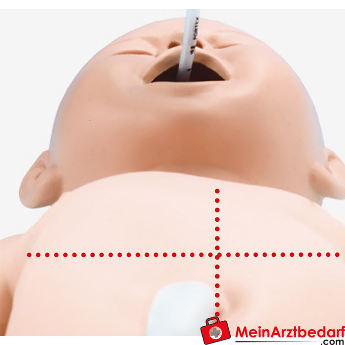 Erler Zimmer Intubation and resuscitation neonate