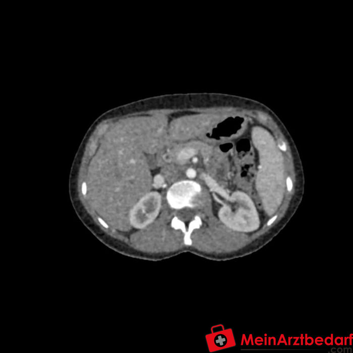 CT, X-ray ve radyoterapi için Erler Zimmer abdominal fantom