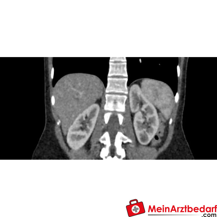 CT, X-ray ve radyoterapi için Erler Zimmer abdominal fantom