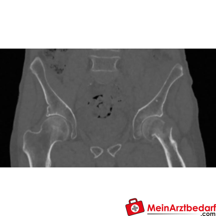 Fantoma pélvico de Erler Zimmer con fractura del cuello femoral para tomografía computarizada, rayos X y radioterapia