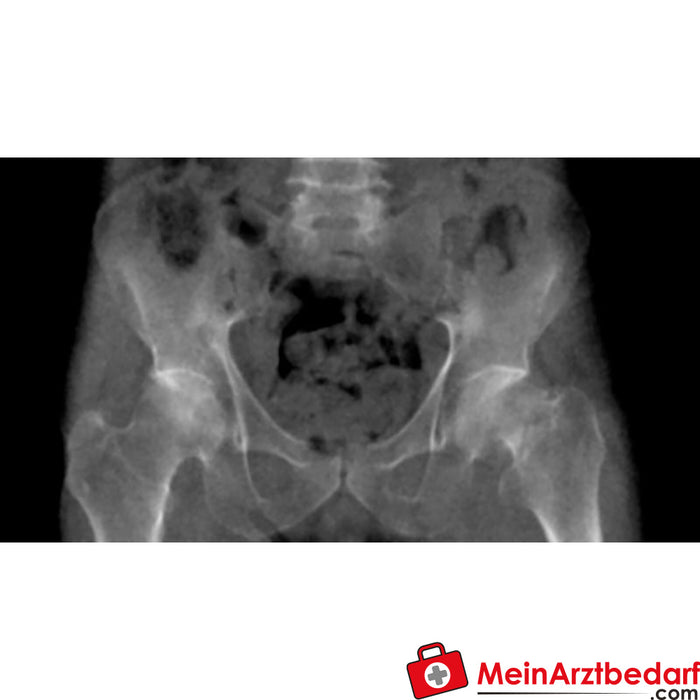 Fantoma pélvico de Erler Zimmer con fractura del cuello femoral para tomografía computarizada, rayos X y radioterapia