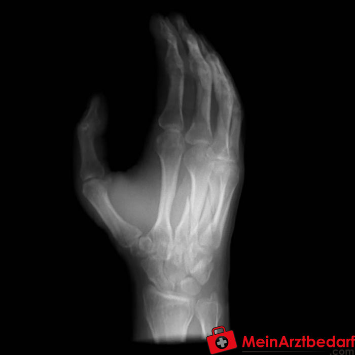 Erler Zimmer 用于 CT、X 射线和放射治疗的手部模型