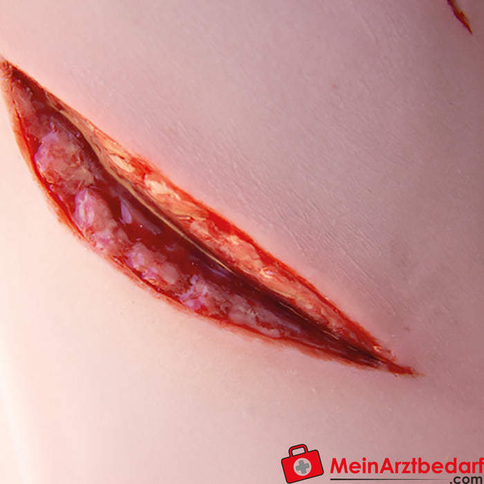 Erler Zimmer wound large with bleeding function