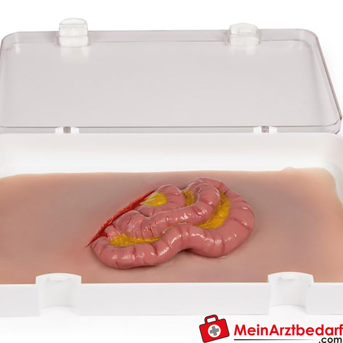 Erler Zimmer Moulage da ferida Saída do intestino delgado