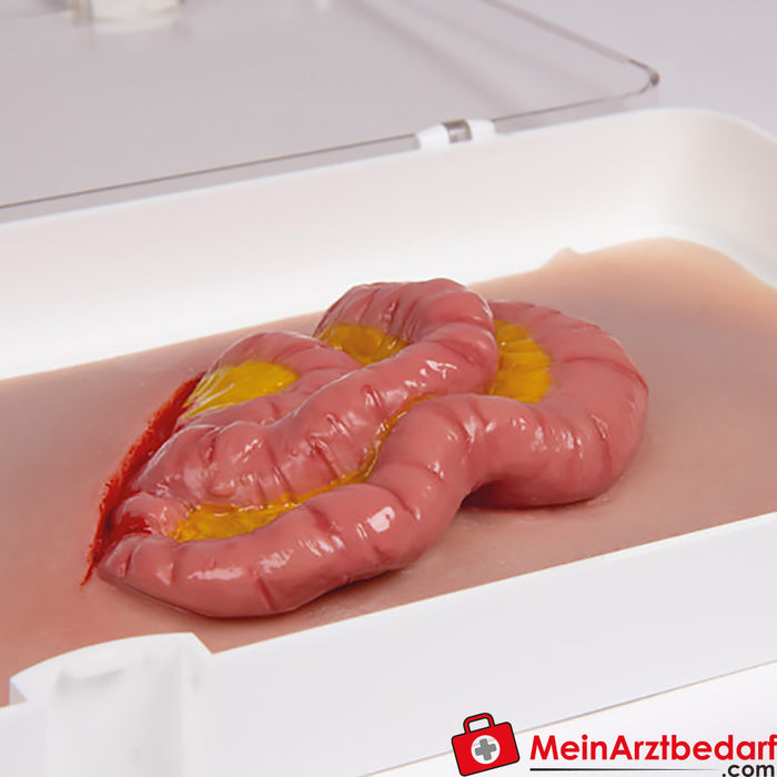 Erler Zimmer Wound moulage Small intestine leakage