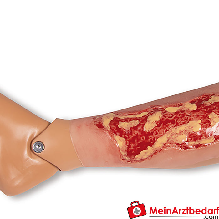 Erler Zimmer Wound Moulage Ulcus Cruris Venosum