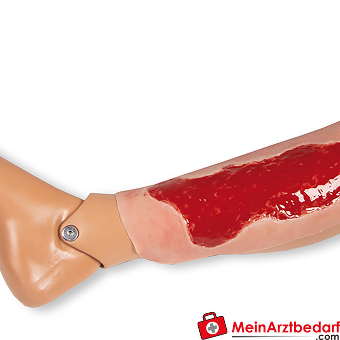 Erler Zimmer Wound Moulage Ulcus Cruris Venosum