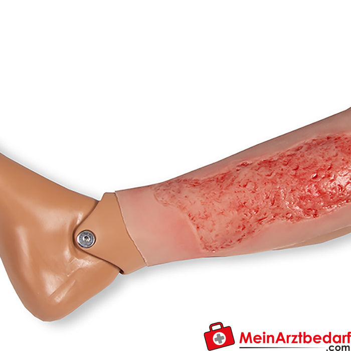 Erler Zimmer Moulage da ferida úlcera venosa da perna