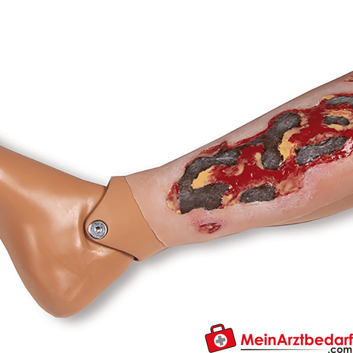 Erler Zimmer Wondmoulage Ulcus Cruris Arteriosum