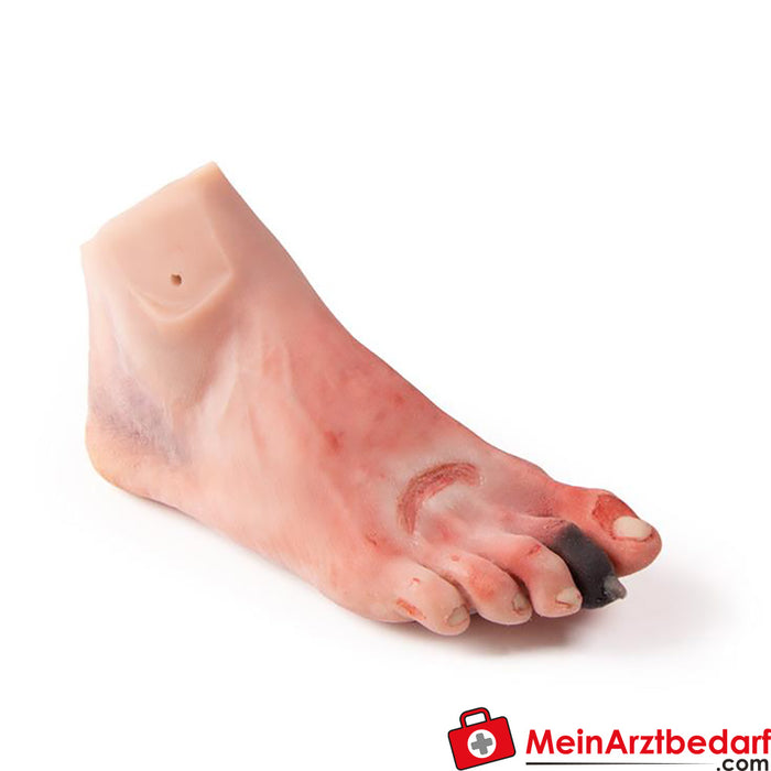Erler Zimmer wound foot with diabetic foot syndrome