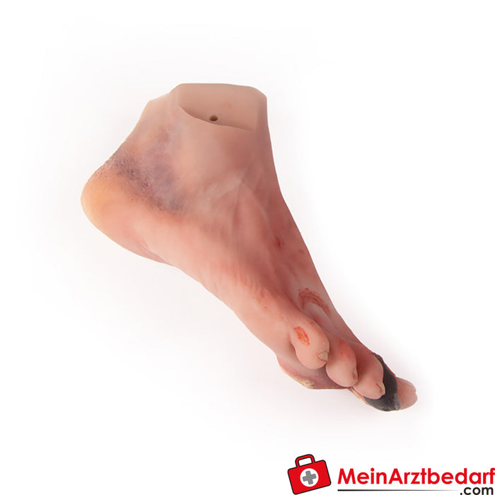 Erler Zimmer wound foot with diabetic foot syndrome