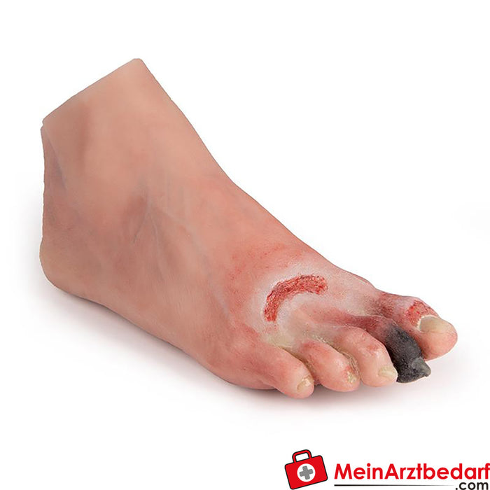 Erler Zimmer wound foot with diabetic foot syndrome