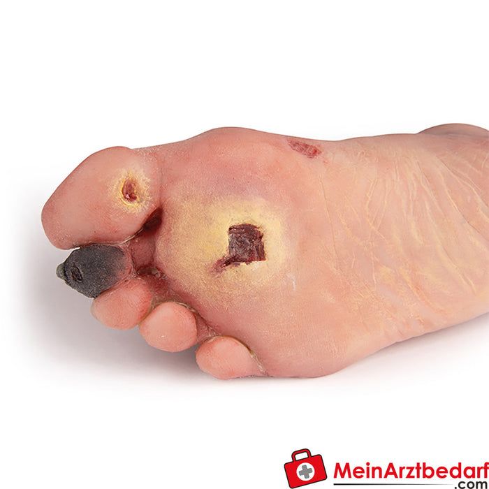 Erler Zimmer wound foot with diabetic foot syndrome