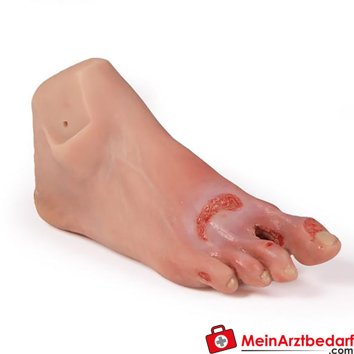 Erler Zimmer wound foot with diabetic foot syndrome