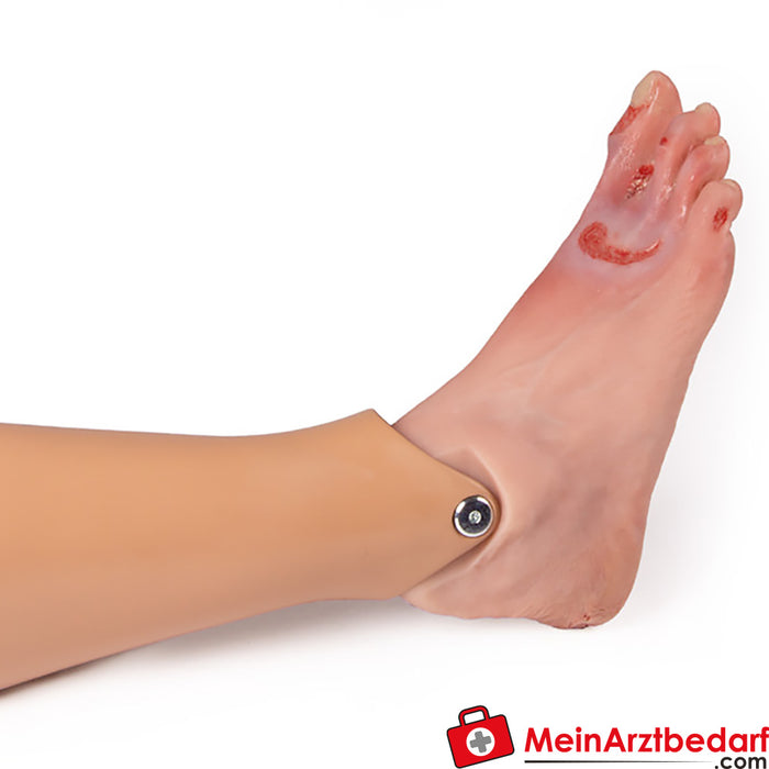 Erler Zimmer wound foot with diabetic foot syndrome