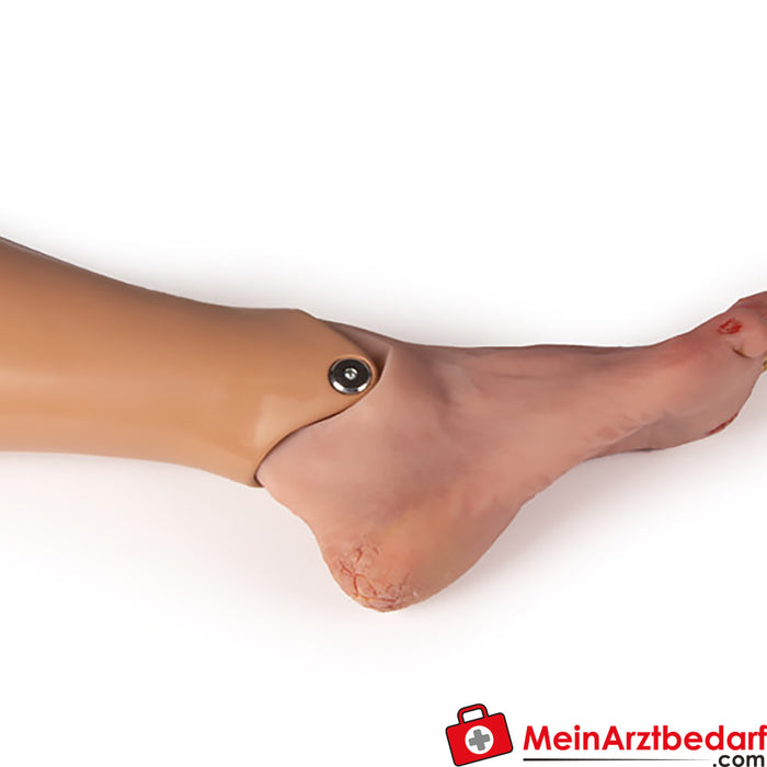 Erler Zimmer wound foot with diabetic foot syndrome