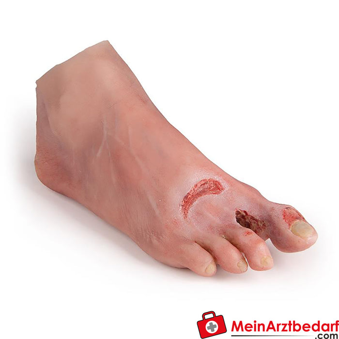 Erler Zimmer wound foot with diabetic foot syndrome