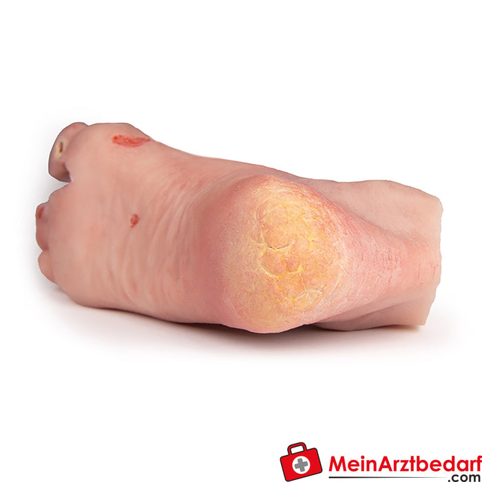 Erler Zimmer wound foot with diabetic foot syndrome