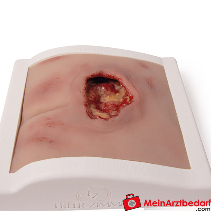 Erler Zimmer Moulage para feridas em decúbito sacral, limpo incl. suporte